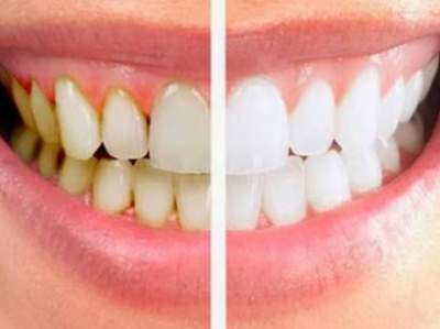 Стоматологи рассказали, как бороться с зубным камнем
