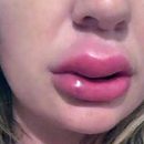 Британка хотела сэкономить на увеличении губ и получила гнойную инфекцию